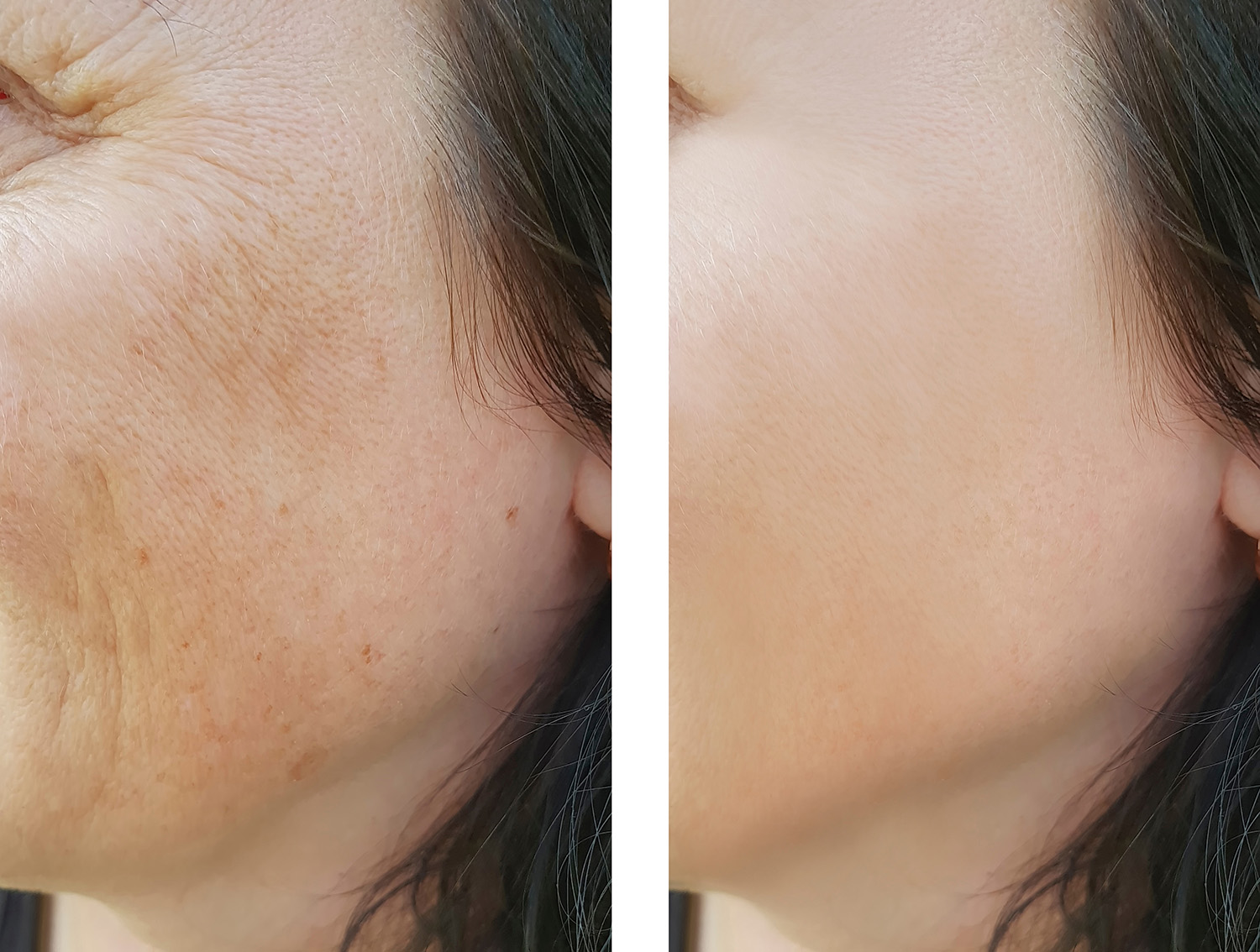 skin-pigmentation-treatment-gresford-skin-laser-clinic-gresford