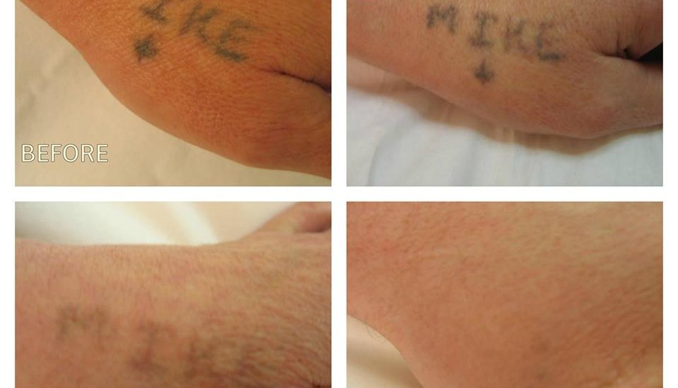 Tattoo Removal in Chester | Tattoo Removal Near Me