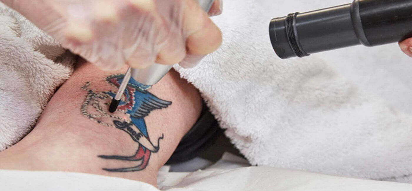 Revolutionising tattoo removal: introducing PicoWay